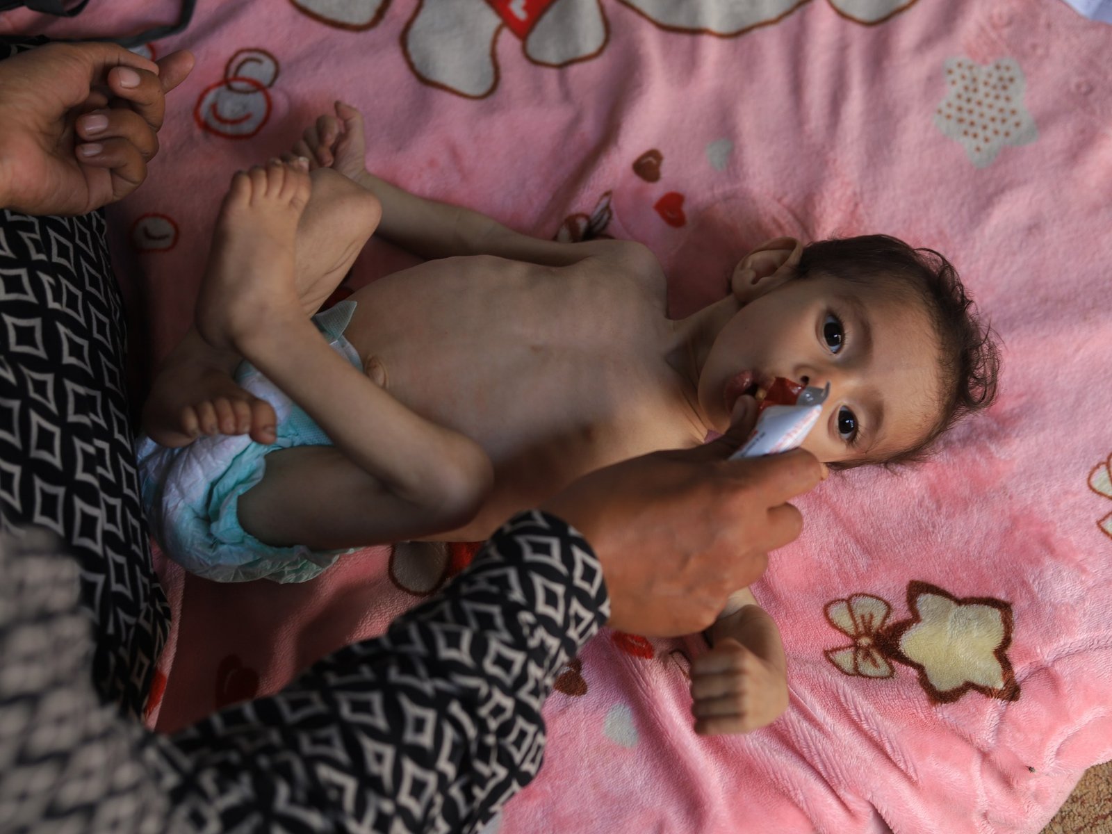 UN warns of surge in acute malnutrition among Gaza’s young children | Hunger News
